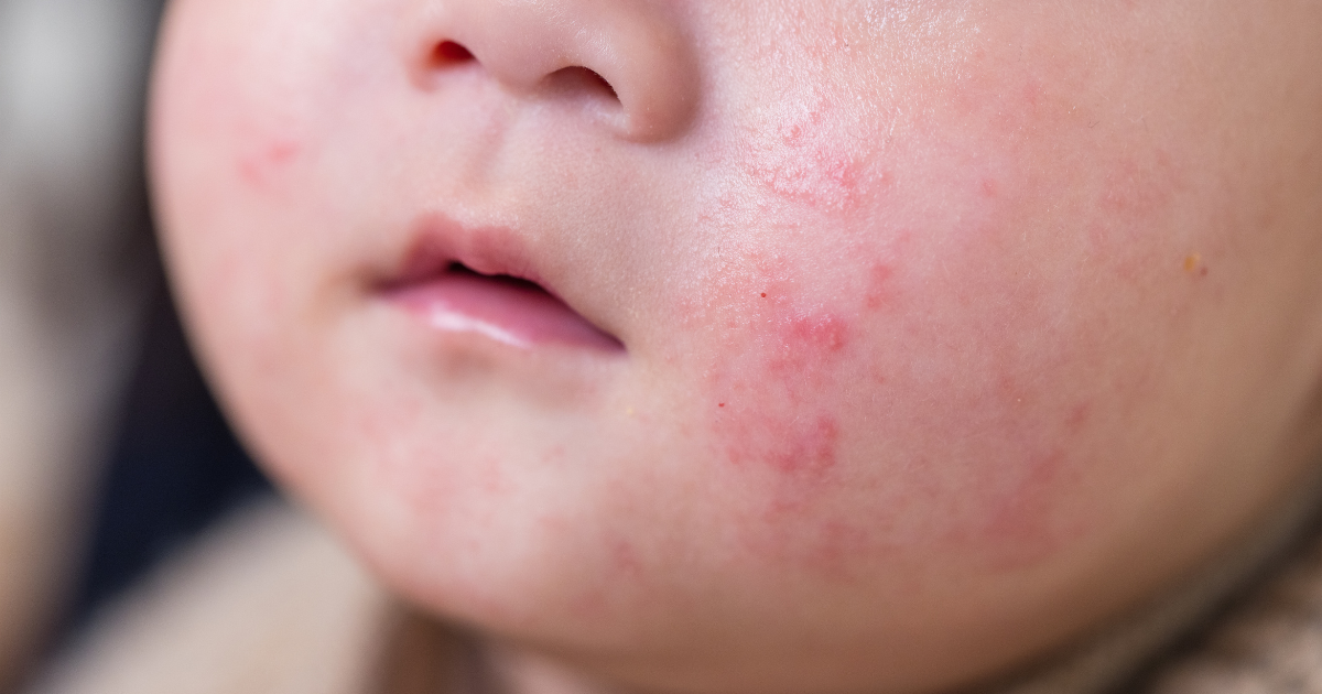 乳児湿疹とアトピーの違いとは？あかちゃんの肌トラブルを正しく知ろう
